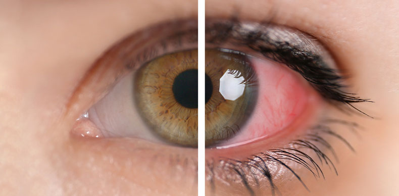 علت سوزش چشم بعد از استفاده از کرم دور چشم